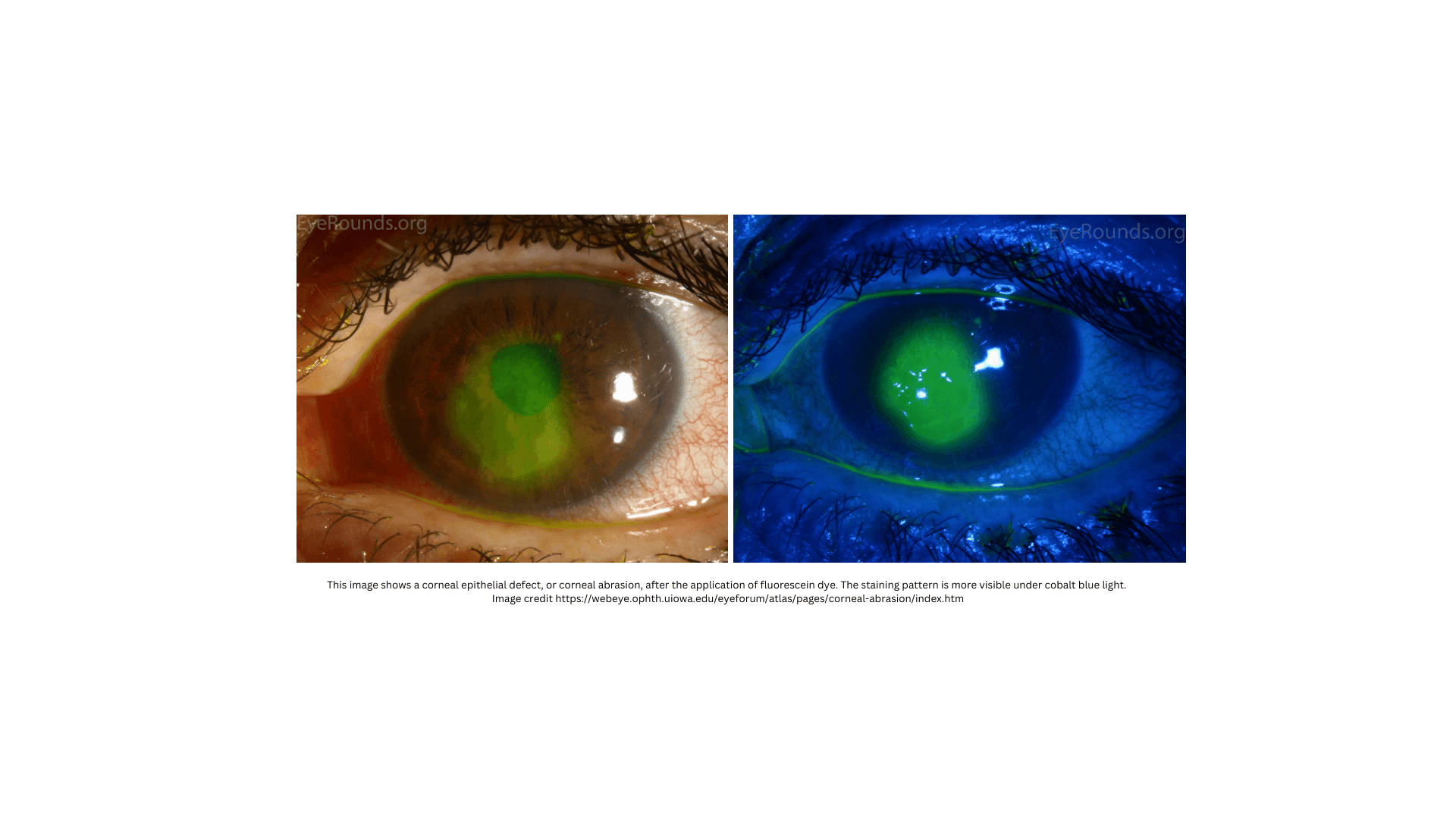 Corneal abrasion